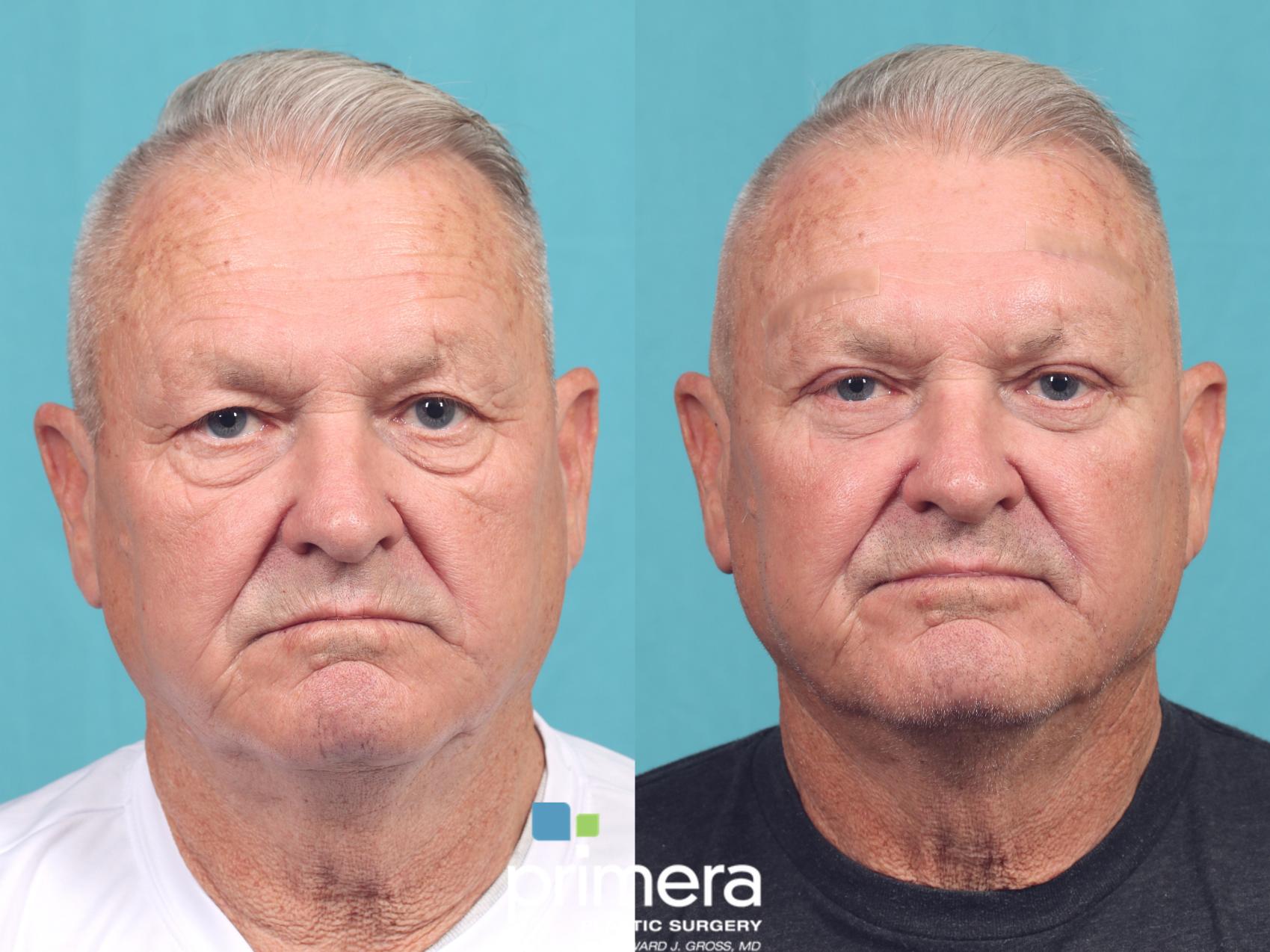 Before & After Blepharoplasty Case 1023 Front View in Orlando, Winter Park & Tampa, Florida