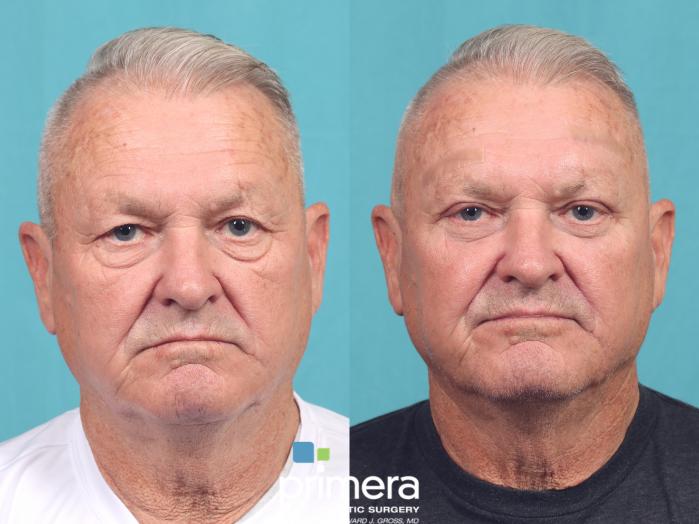 Before & After Blepharoplasty Case 1023 Front View in Orlando, Winter Park & Tampa, Florida