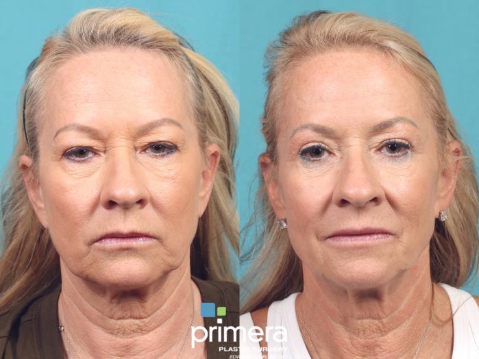 Before & After Blepharoplasty Case 1026 Front View in Orlando, Winter Park & Tampa, Florida