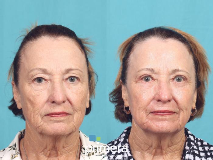 Before & After Blepharoplasty Case 1045 Front View in Orlando, Winter Park & Tampa, Florida