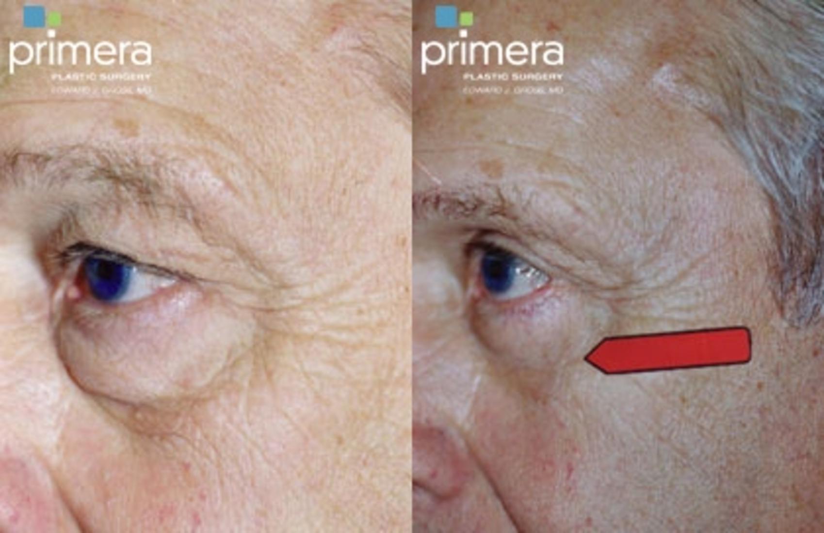 Before & After Blepharoplasty Case 113 view-1 View in Orlando, Florida
