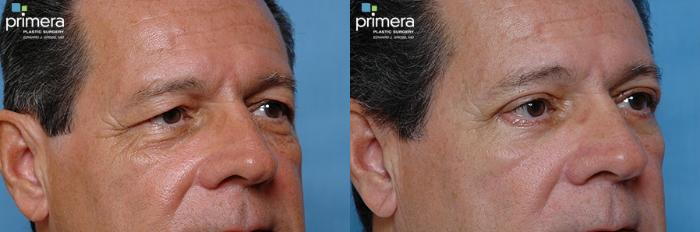 Before & After Blepharoplasty Case 12 view-1 View in Orlando, Florida