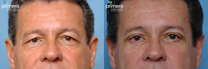 Before & After Blepharoplasty Case 12 view-2 View in Orlando, Florida