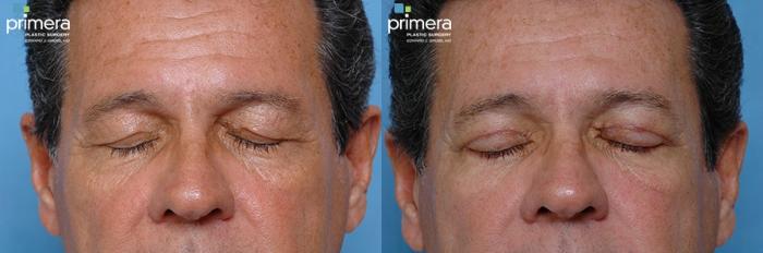 Before & After Blepharoplasty Case 12 view-4 View in Orlando, Florida