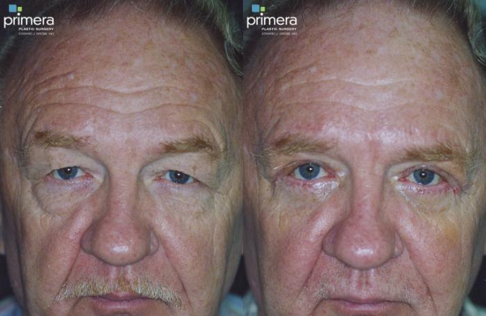 Before & After Blepharoplasty Case 120 view-1 View in Orlando, Florida