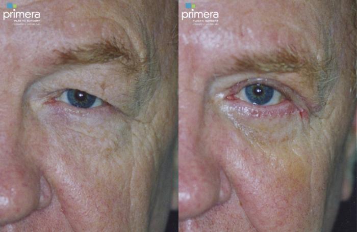 Before & After Blepharoplasty Case 120 view-2 View in Orlando, Florida