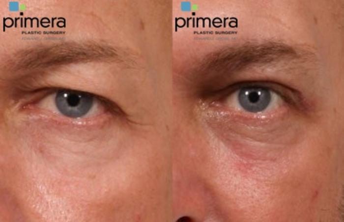 Before & After Blepharoplasty Case 121 view-1 View in Orlando, Florida