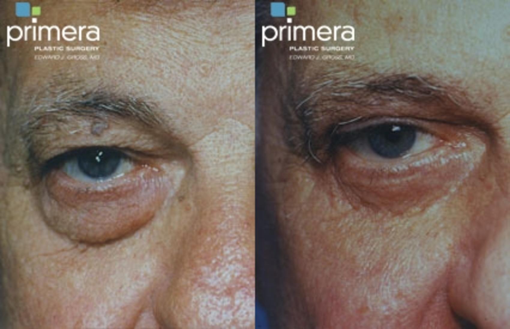 Before & After Blepharoplasty Case 122 view-1 View in Orlando, Florida