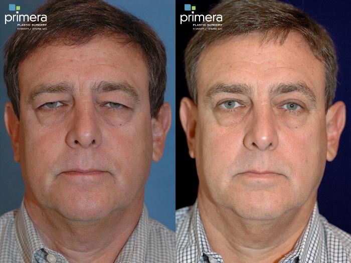 Before & After Blepharoplasty Case 123 view-1 View in Orlando, Florida