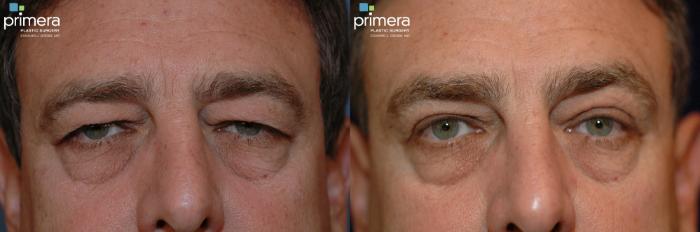 Before & After Blepharoplasty Case 123 view-2 View in Orlando, Florida