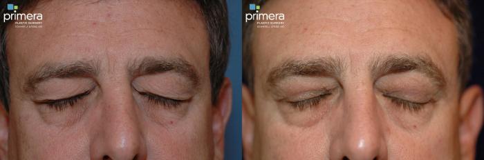 Before & After Blepharoplasty Case 123 view-3 View in Orlando, Florida