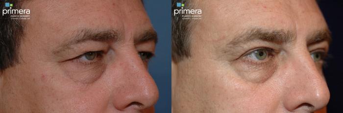 Before & After Blepharoplasty Case 123 view-4 View in Orlando, Florida