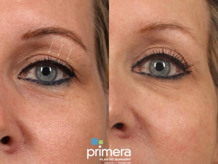 Before & After BOTOX® Cosmetic Case 13 Front View in Orlando, Florida