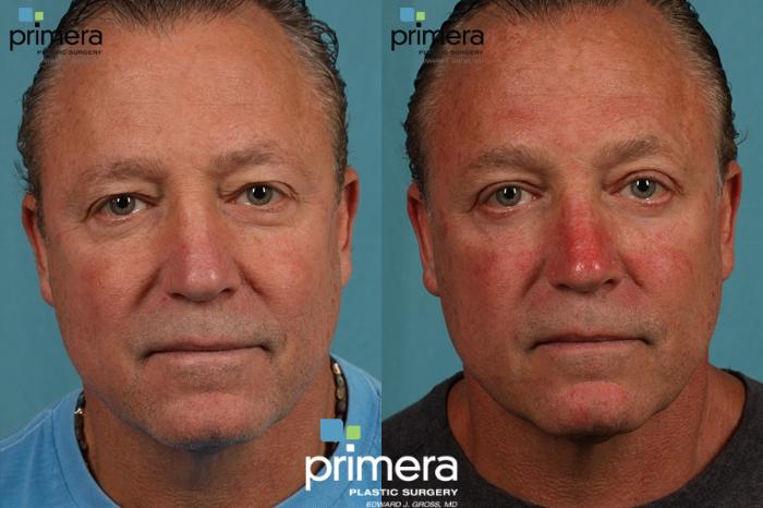 Before & After Surgery for Men Case 14 view-2 View in Orlando, Florida