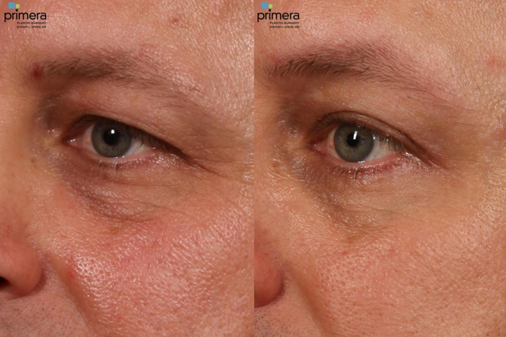 Before & After BOTOX® Cosmetic Case 15 view-1 View in Orlando, Florida