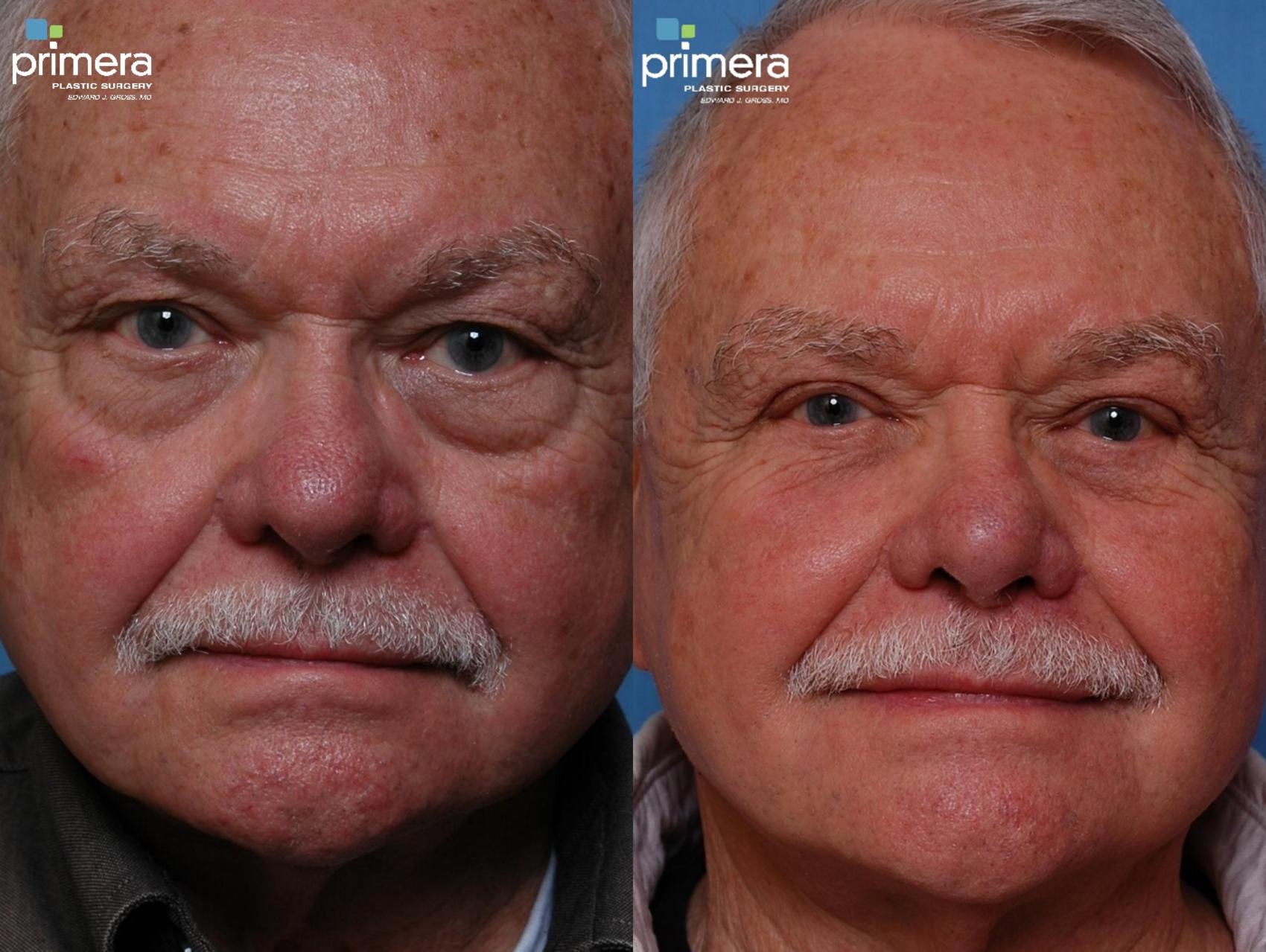 Before & After Blepharoplasty Case 19 view-1 View in Orlando, Florida