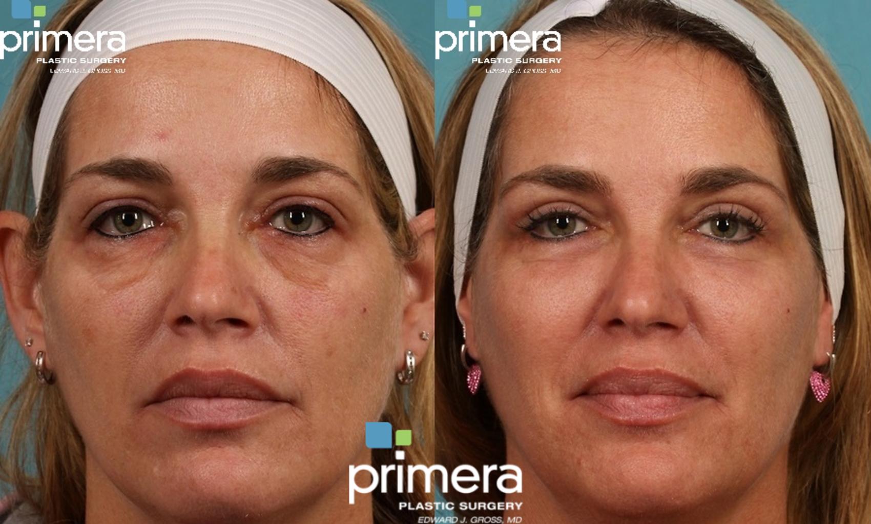 Before & After Blepharoplasty Case 191 view-1 View in Orlando, Florida