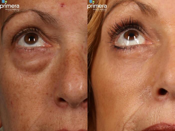 Before & After Blepharoplasty Case 202 view-1 View in Orlando, Florida