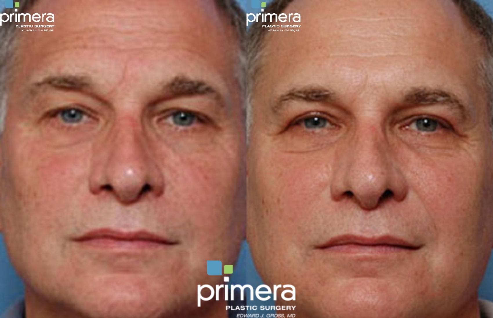 Before & After Surgery for Men Case 253 view-1 View in Orlando, Florida