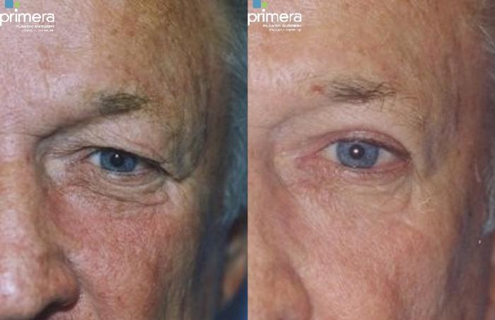 Before & After Blepharoplasty Case 255 view-1 View in Orlando, Florida