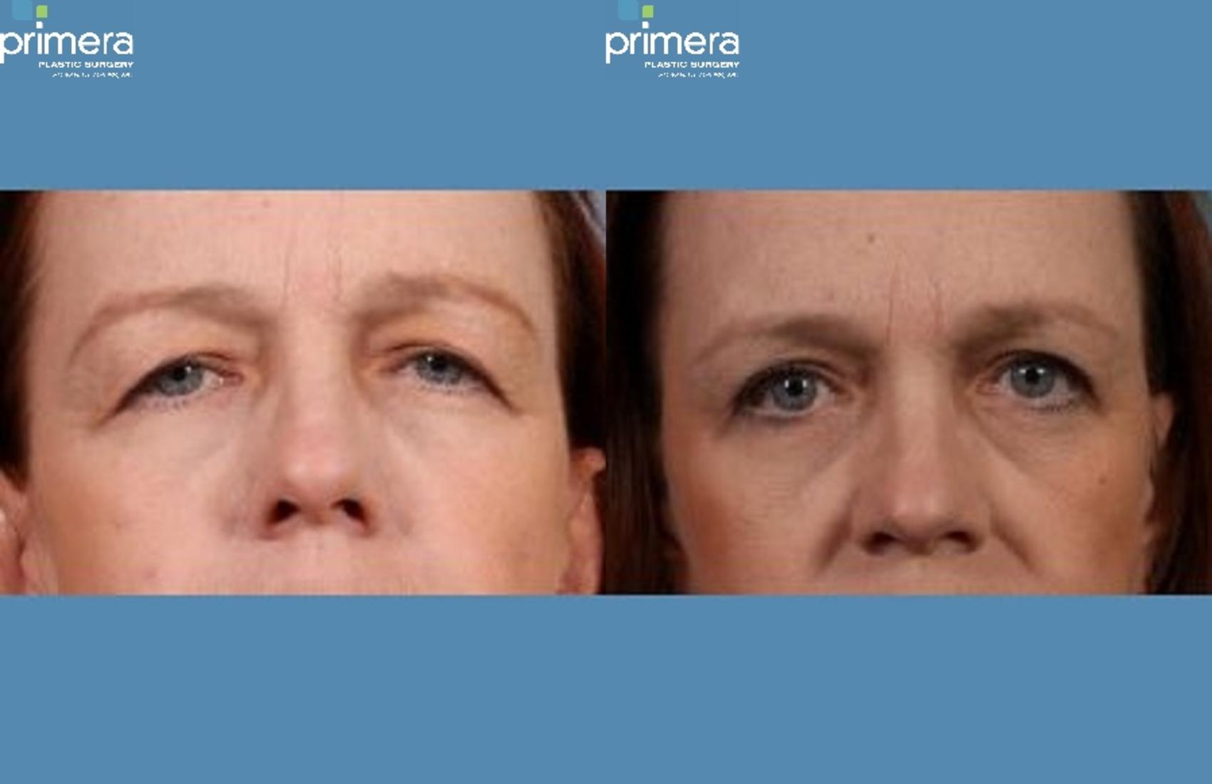 Before & After Blepharoplasty Case 256 Front View in Orlando, Florida