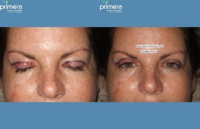Before & After Blepharoplasty Case 262 view-1 View in Orlando, Florida