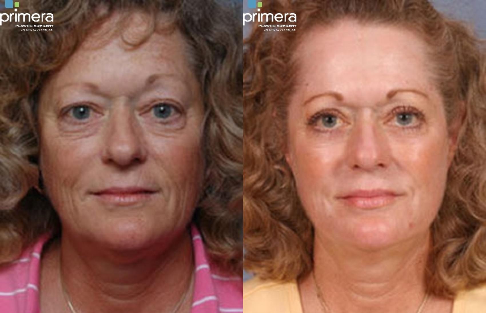 Before & After Blepharoplasty Case 264 view-1 View in Orlando, Florida