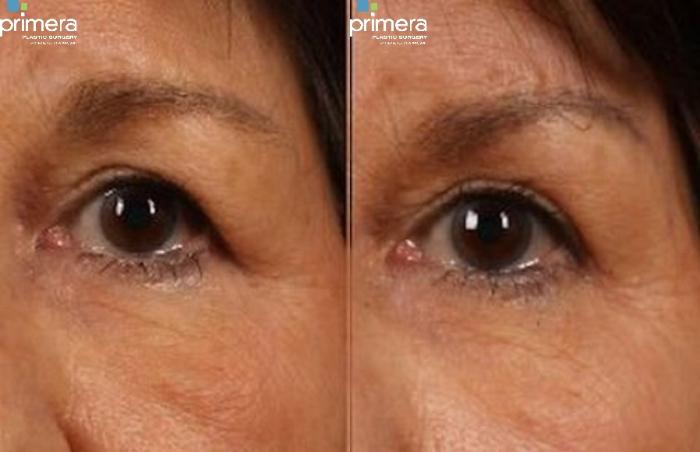 Before & After Brow Lift Case 267 view-1 View in Orlando, Florida