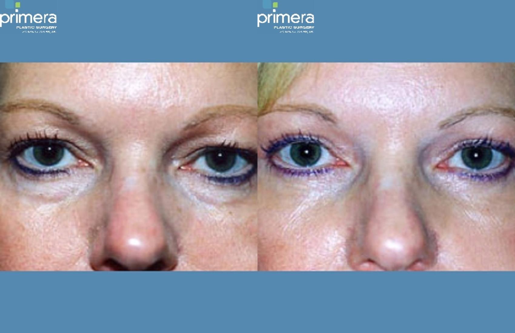 Before & After Blepharoplasty Case 268 view-1 View in Orlando, Florida