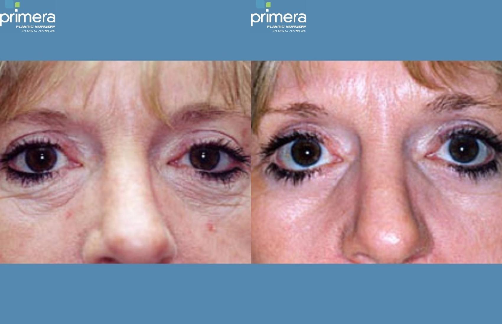 Before & After Blepharoplasty Case 269 view-1 View in Orlando, Florida