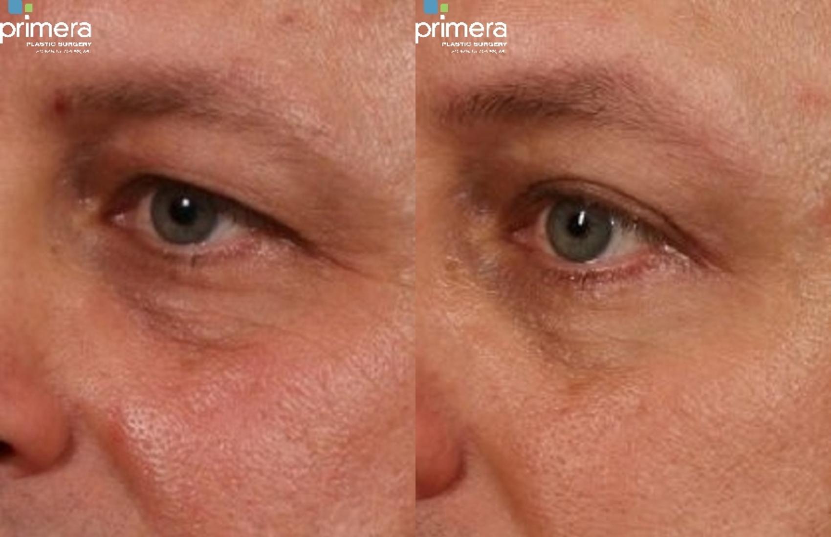 Before & After Blepharoplasty Case 270 view-1 View in Orlando, Florida
