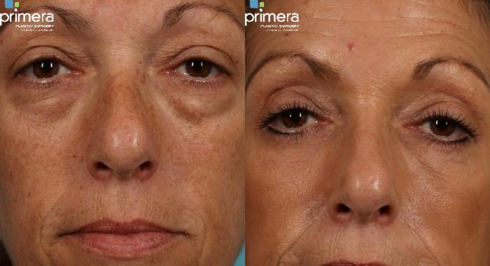 Before & After Blepharoplasty Case 274 view-1 View in Orlando, Florida