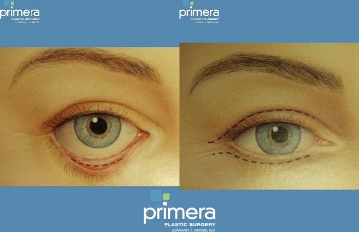 Before & After Blepharoplasty Case 275 view-1 View in Orlando, Florida