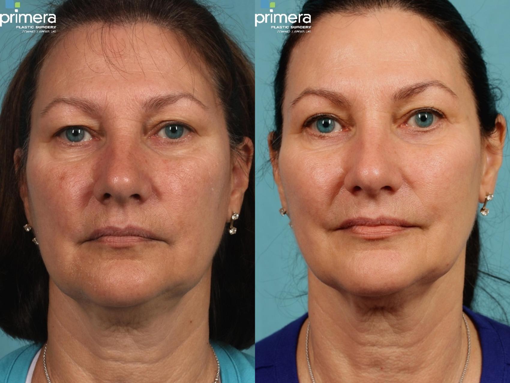 Eyelid Surgery Blepharoplasty Botox In Orlando