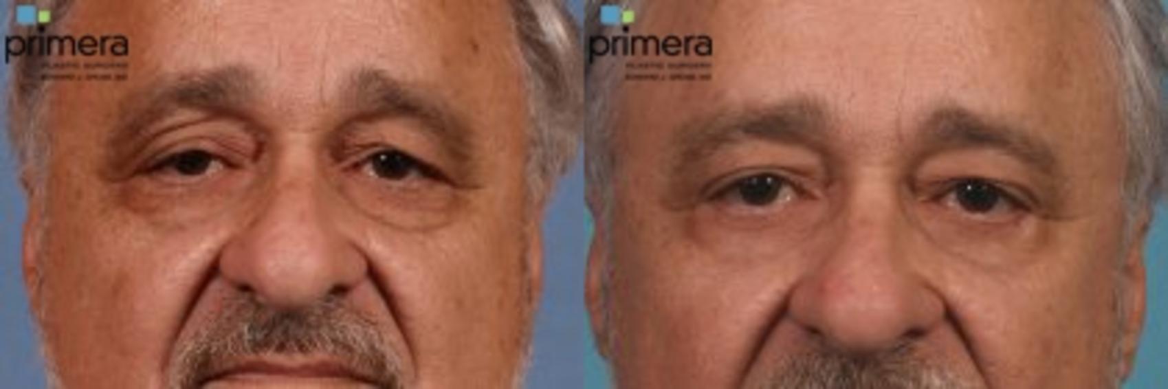 Before & After Blepharoplasty Case 30 view-1 View in Orlando, Florida