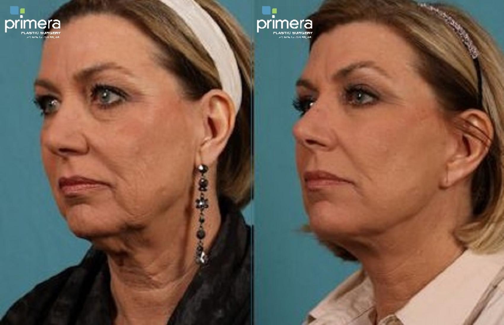Before & After Blepharoplasty Case 304 view-1 View in Orlando, Florida
