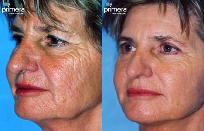 Before & After Laser Skin Resurfacing (DOT CO2) Case 309 view-1 View in Orlando, Florida