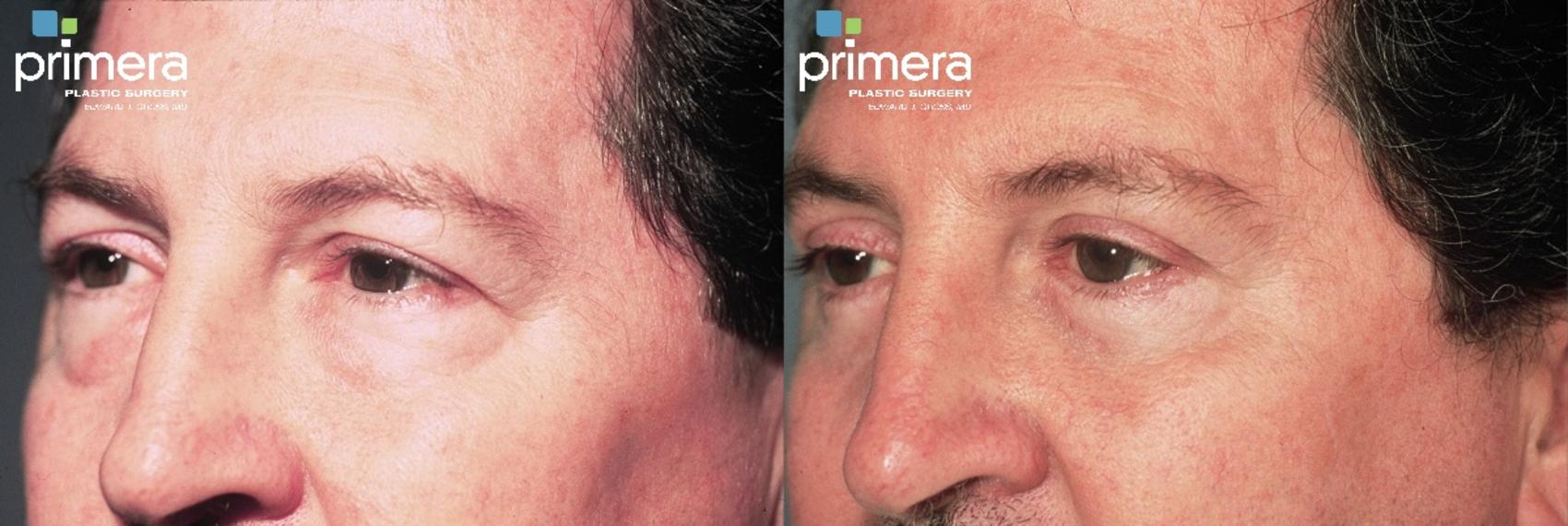Before & After Blepharoplasty Case 323 view-1 View in Orlando, Florida