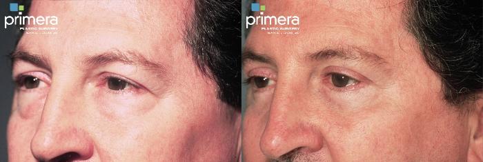 Before & After BOTOX® Cosmetic Case 323 view-1 View in Orlando, Florida