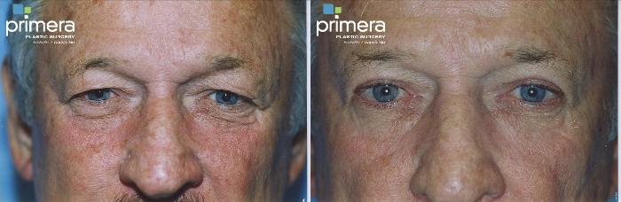 Before & After Blepharoplasty Case 327 view-1 View in Orlando, Florida