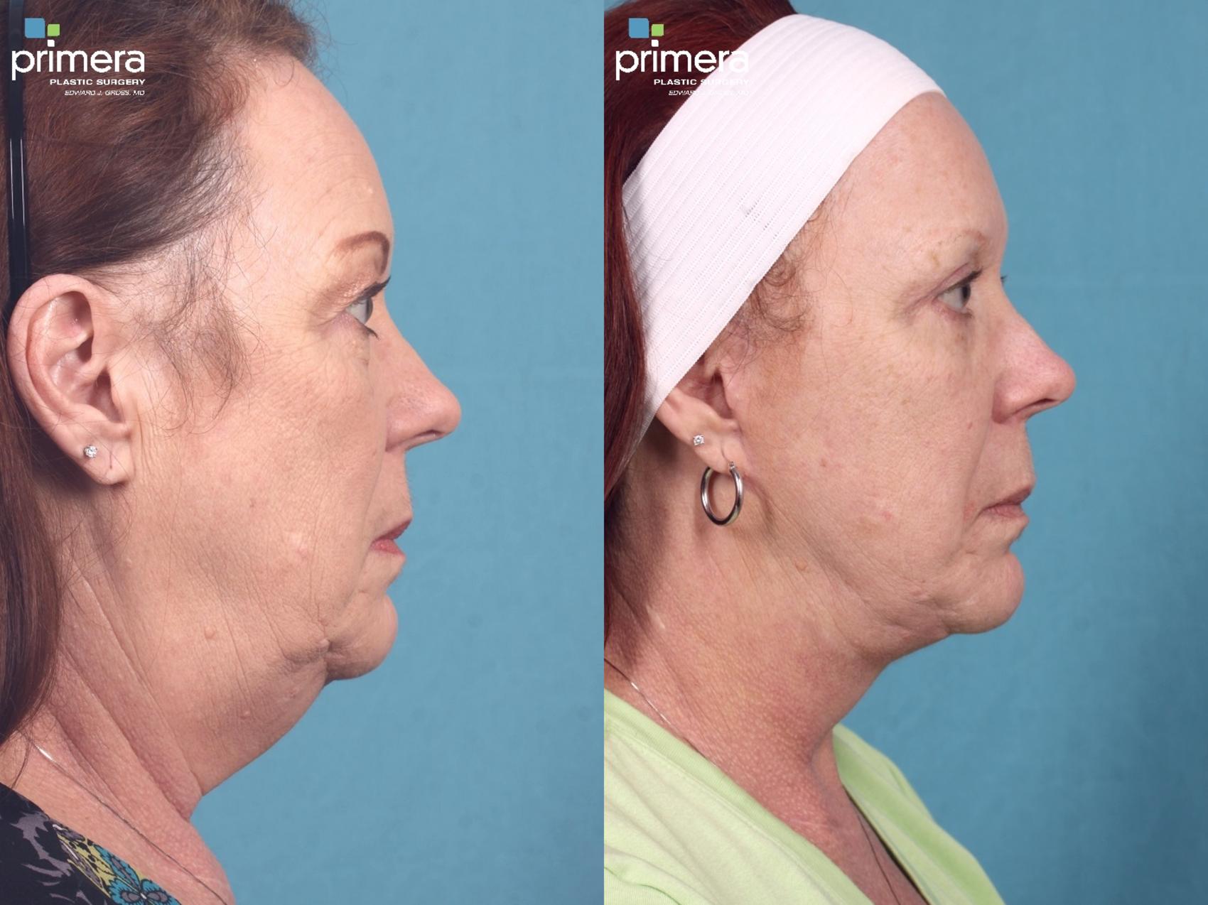 Before & After Facelift Case 333 view-1 View in Orlando, Florida