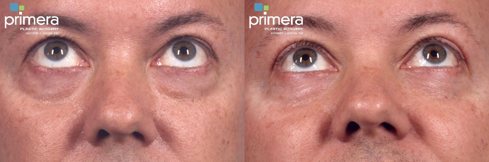 Before & After Blepharoplasty Case 343 view-1 View in Orlando, Florida