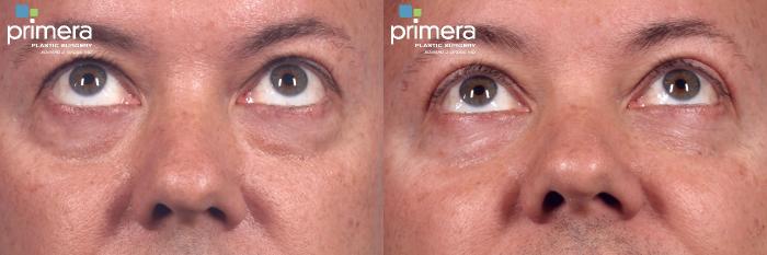 Before & After Blepharoplasty Case 343 view-1 View in Orlando, Florida