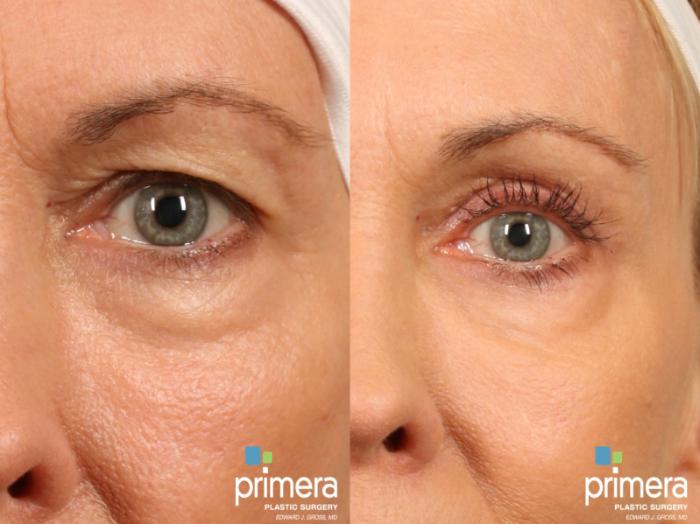Before & After BOTOX® Cosmetic Case 363 view-1 View in Orlando, Florida