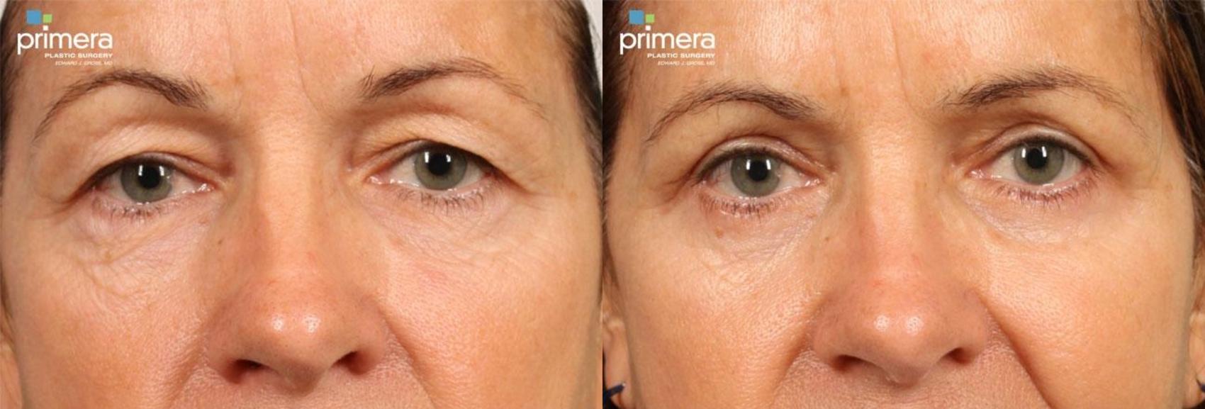 Before & After Blepharoplasty Case 430 view-1 View in Orlando, Florida
