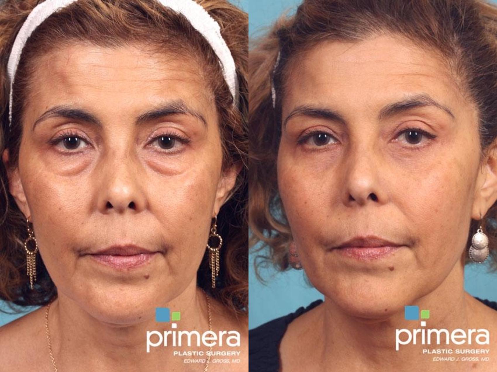 Before & After Blepharoplasty Case 492 view-1 View in Orlando, Florida