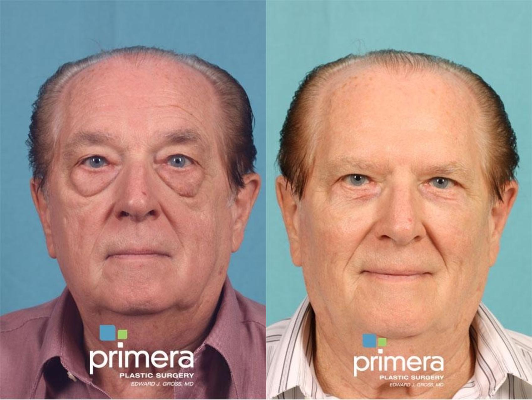 Before & After Blepharoplasty Case 502 view-1 View in Orlando, Florida