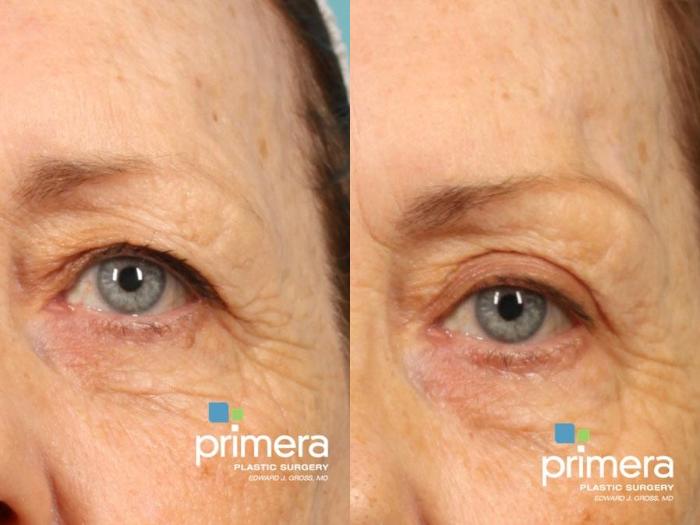 Before & After Blepharoplasty Case 520 view-1 View in Orlando, Florida