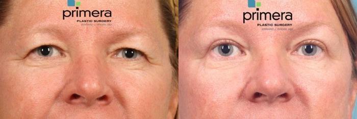 Before & After Blepharoplasty Case 561 view-1 View in Orlando, Florida