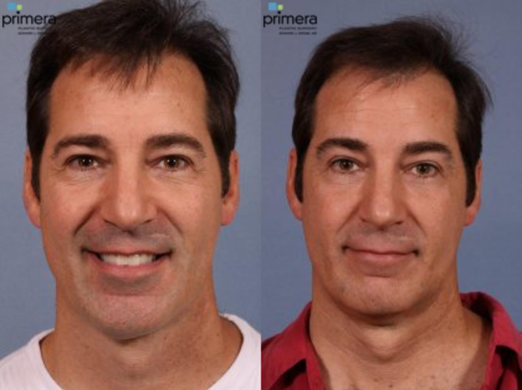 Before & After Blepharoplasty Case 57 view-1 View in Orlando, Florida